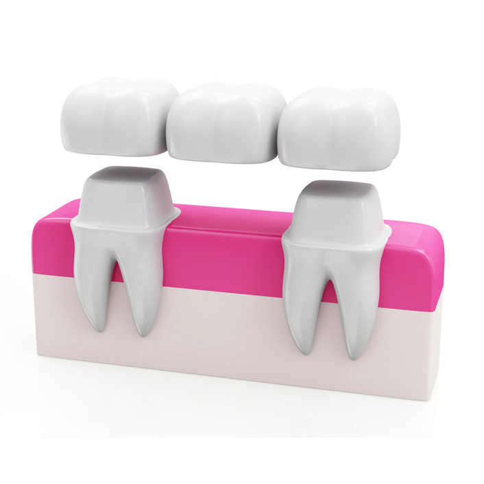 Bridges - Dental Services